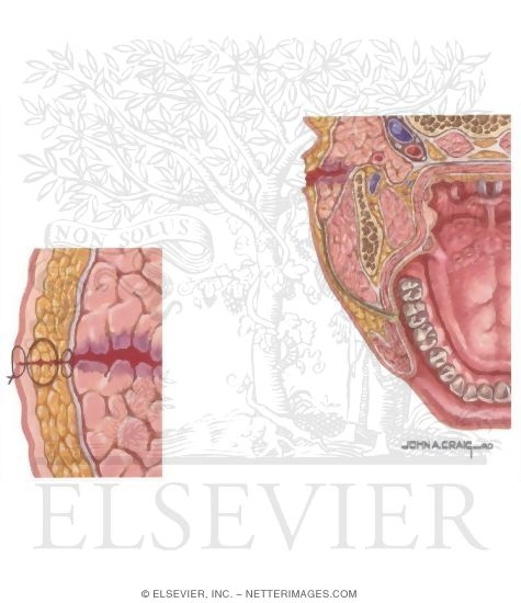 Fistulas and Sialoceles
