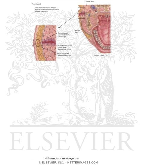 Watermarked preview of labeled image: Fistulas and Sialoceles