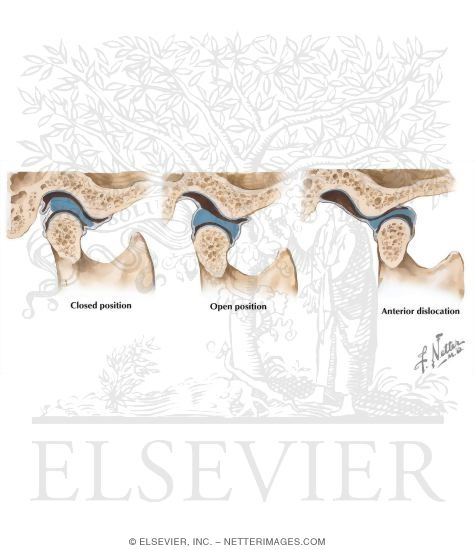 Watermarked preview of labeled image: Mandibular Dislocation