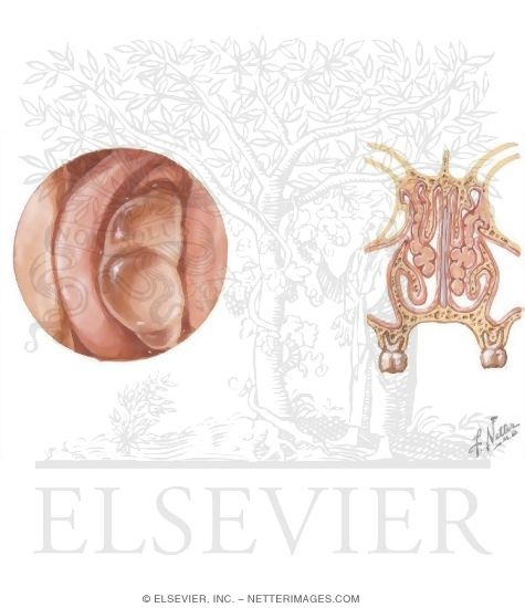Watermarked preview of unlabeled image: Rhinitis