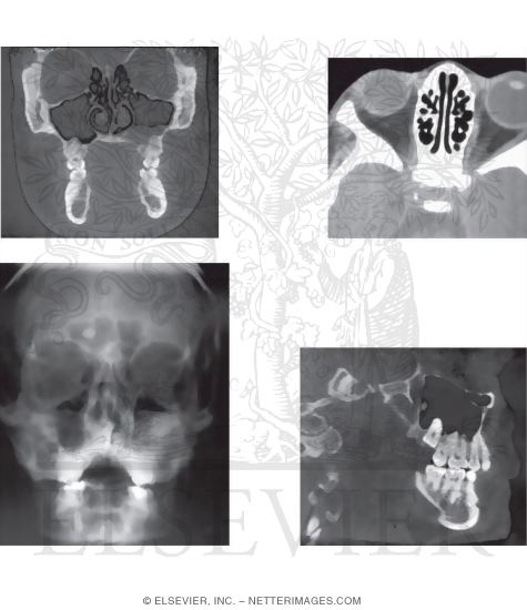 Imaging of the Paranasal Sinuses