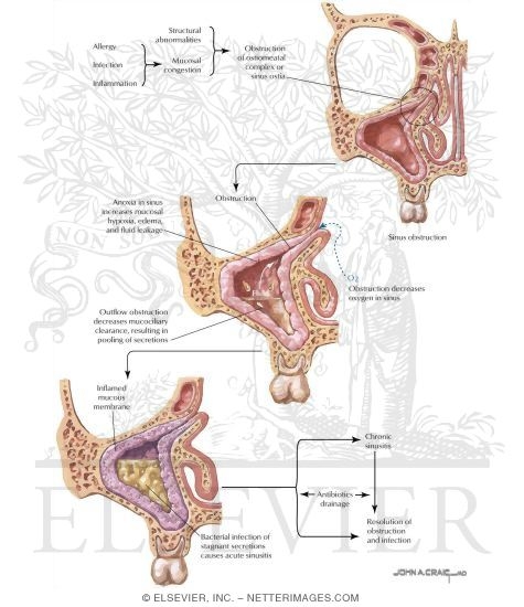 Pathogenesis of Sinusitis