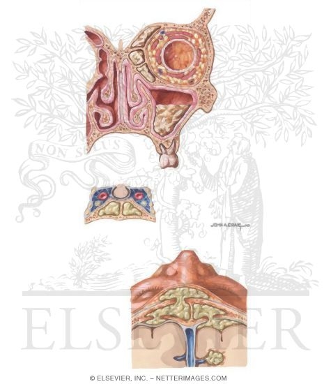 Watermarked preview of unlabeled image: Potential Spread of Infection Via the Paranasal Sinuses