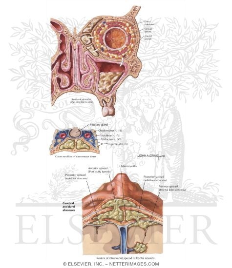 Watermarked preview of labeled image: Potential Spread of Infection Via the Paranasal Sinuses