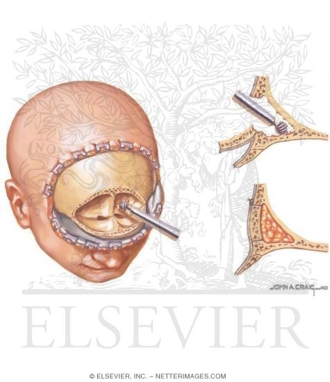 Surgical Procedures: Frontal Sinus Obliteration