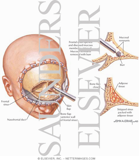 Surgical Procedures: Frontal Sinus Obliteration
