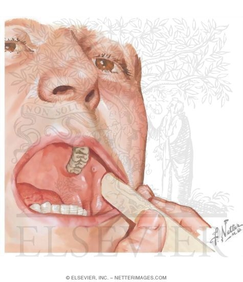 Boundaries of the Oral Cavity: Lateral Border - Cheek