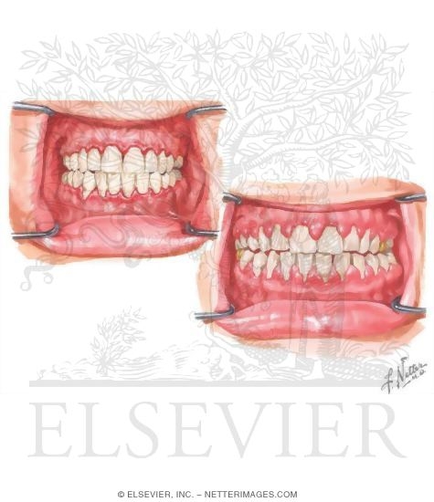 Watermarked preview of unlabeled image: Gingivitis
