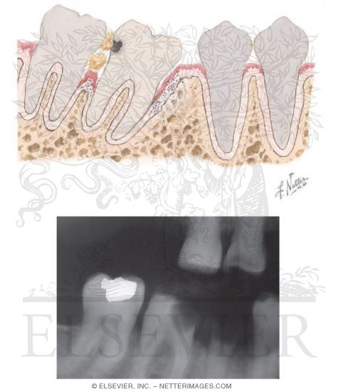 Watermarked preview of unlabeled image: Dental Caries