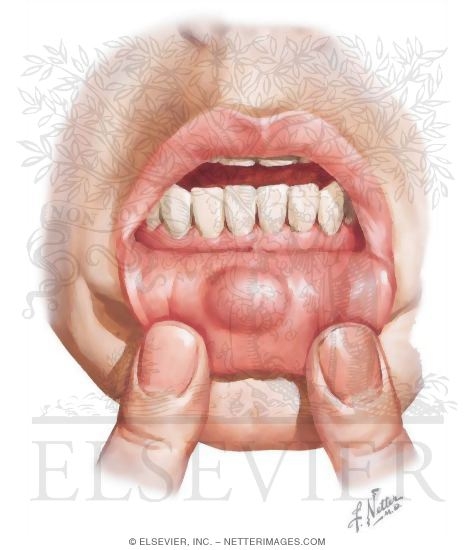 Mucocele
