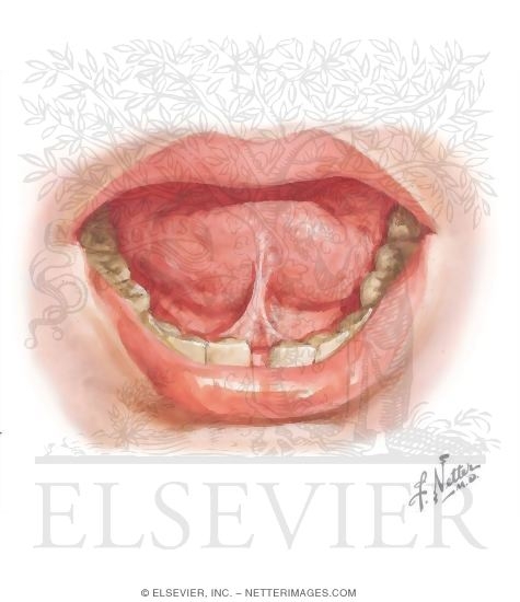 Ankyloglossia