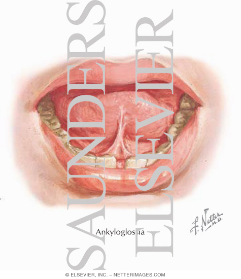 Watermarked preview of labeled image: Ankyloglossia