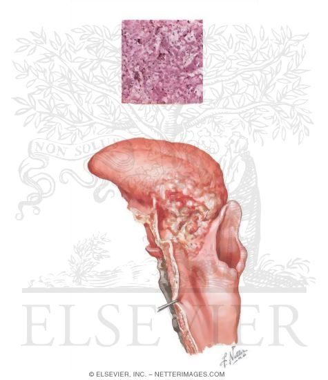 Watermarked preview of unlabeled image: Squamous Cell Carcinoma