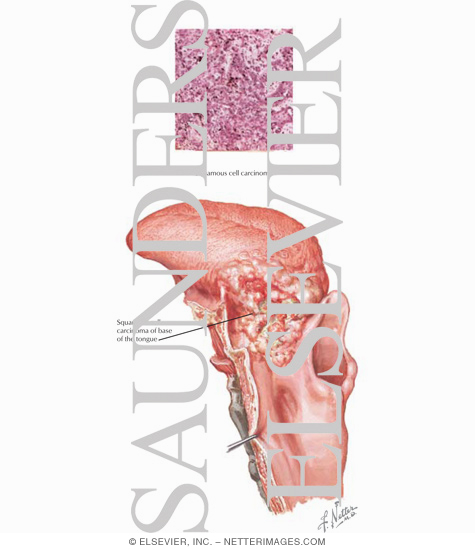 Watermarked preview of labeled image: Squamous Cell Carcinoma