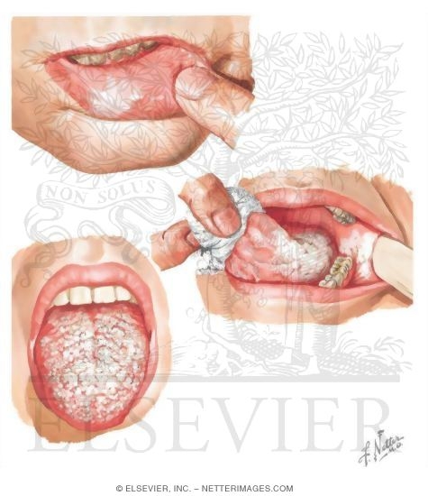Leukoplakia