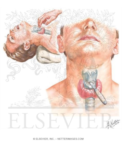 Watermarked preview of unlabeled image: Emergency Airway: Cricothyrotomy