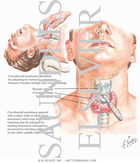 Watermarked preview of labeled image: Emergency Airway: Cricothyrotomy