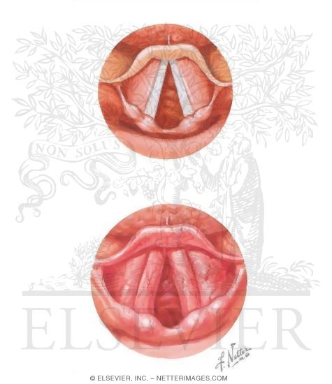 Watermarked preview of unlabeled image: Laryngitis