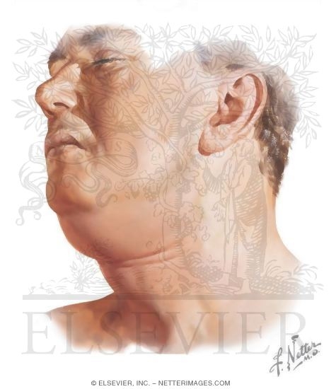Ludwig's Angina