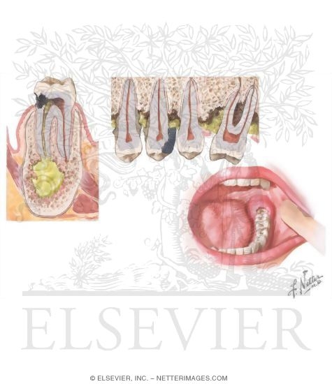 Watermarked preview of unlabeled image: Abscesses