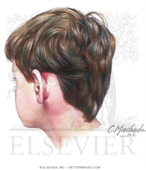 Mastoiditis