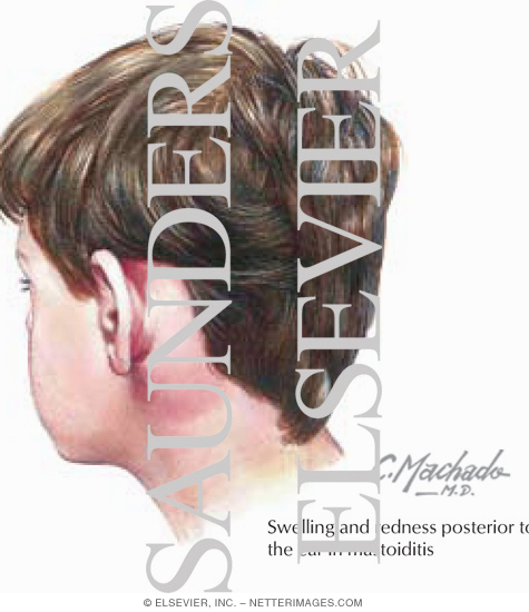Watermarked preview of labeled image: Mastoiditis