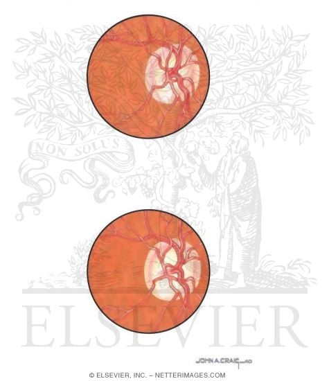 Watermarked preview of unlabeled image: Glaucoma
