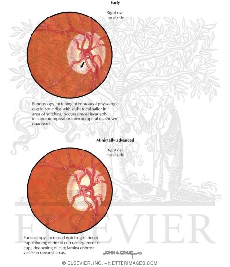 Watermarked preview of labeled image: Glaucoma
