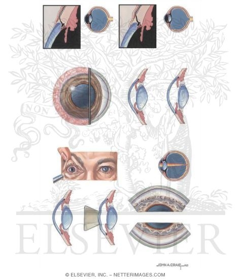 Watermarked preview of unlabeled image: Glaucoma