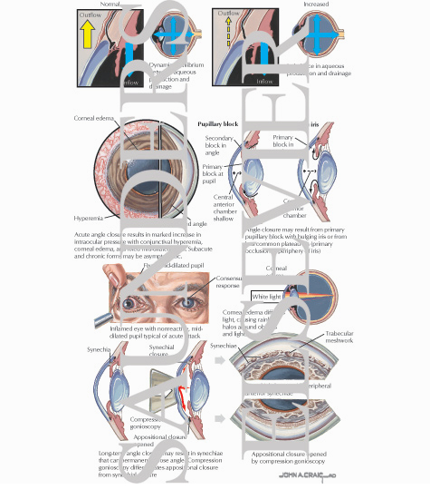 Glaucoma