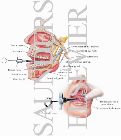 Mandibular Injections: Inferior Alveolar Nerve Block