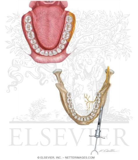 Long Buccal Nerve Block
