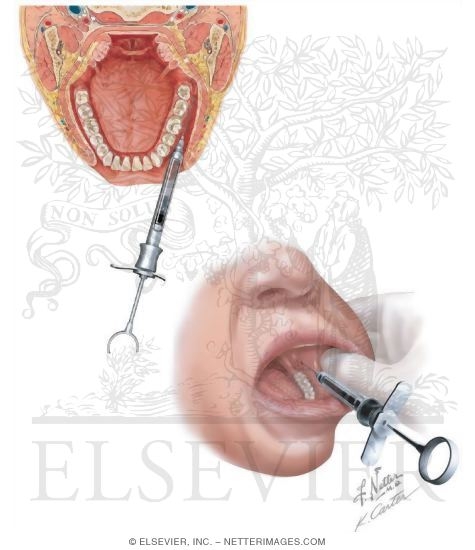 Long Buccal Nerve Block