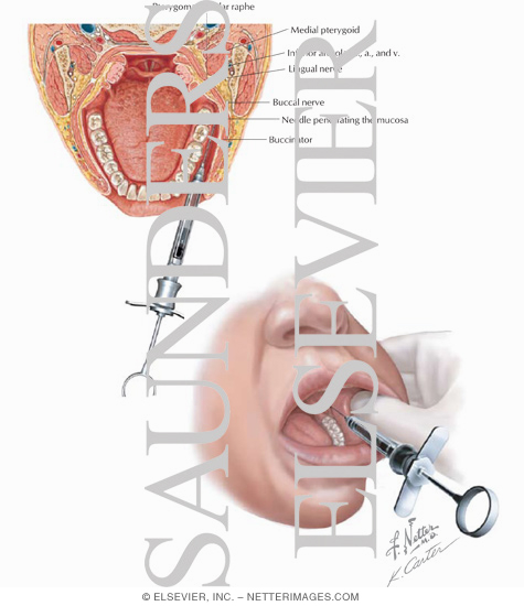 Long Buccal Nerve Block
