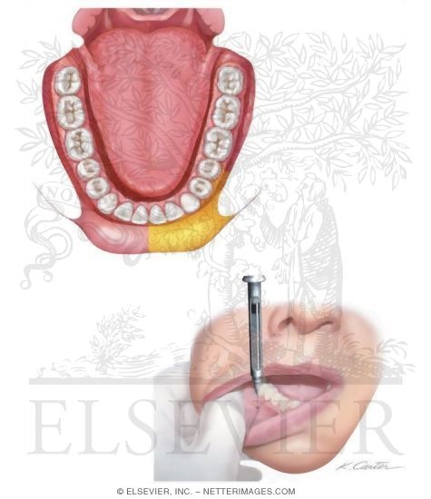 Mental Nerve Block
