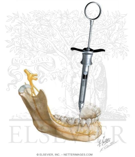 Mental Nerve Block