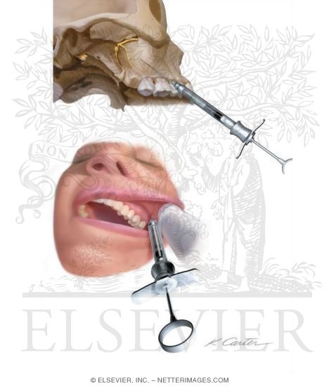 Maxillary Injections: Posterior Superior Alveolar Nerve Block