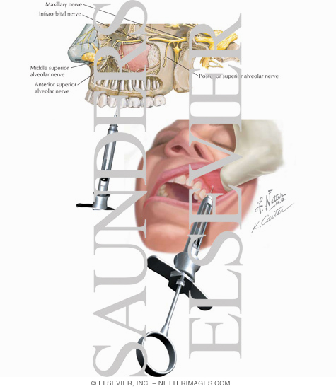 Watermarked preview of labeled image: Maxillary Injections: Middle Superior Alveolar Nerve Block