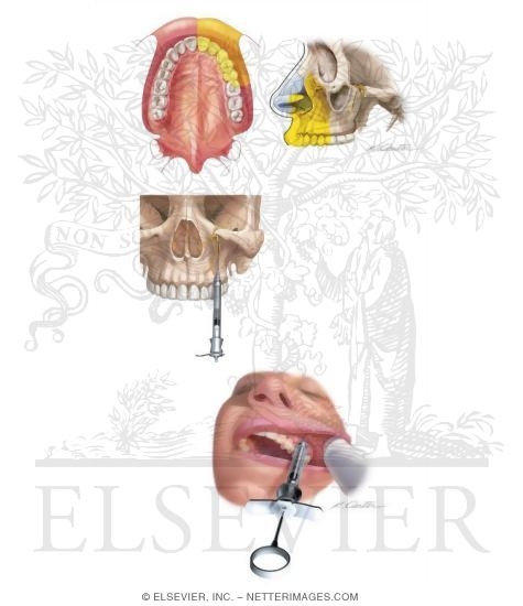 Maxillary Injections: Infraorbital, Anterior Superior Alveolar Nerve Block
