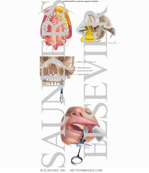 Maxillary Injections: Infraorbital, Anterior Superior Alveolar Nerve Block