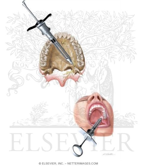 Watermarked preview of unlabeled image: Maxillary Injections: Maxillary Division Block