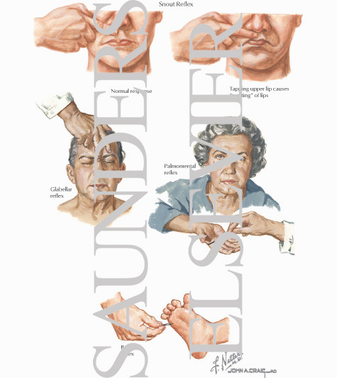 Watermarked preview of labeled image: Reflex Examination - Pathologic