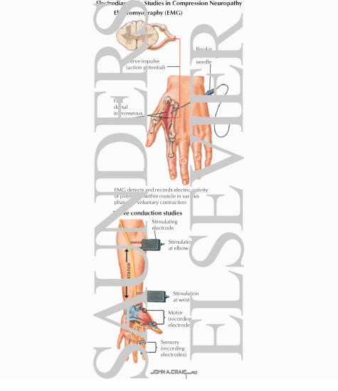 Watermarked preview of labeled image: Electrodiagnostic Studies in Compression Neuropathy