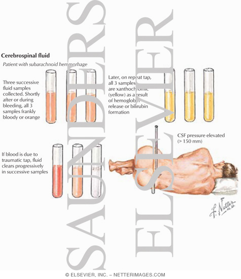 Lumbar Puncture