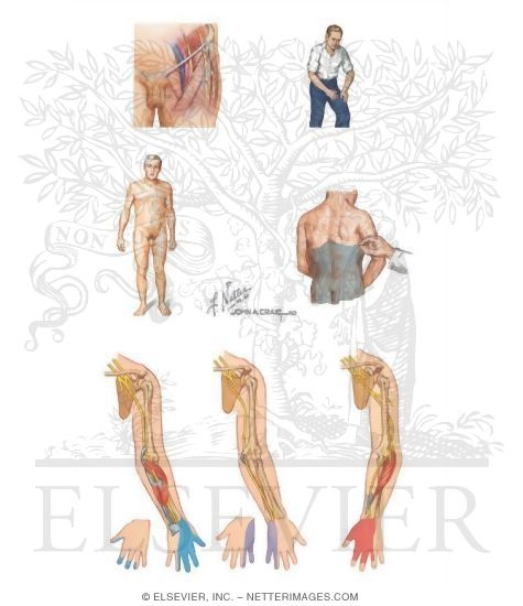 Watermarked preview of unlabeled image: Sensation: Cutaneous Sensory Deficit