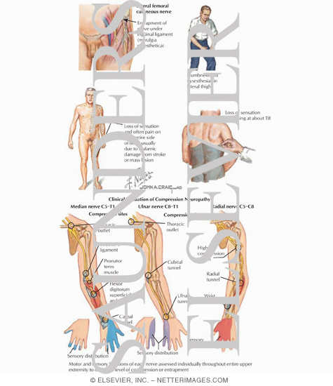Watermarked preview of labeled image: Sensation: Cutaneous Sensory Deficit