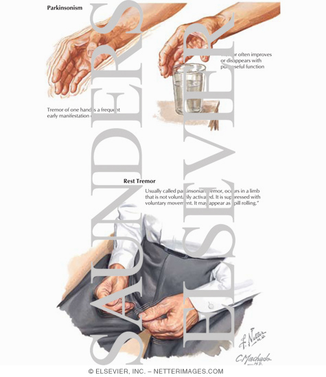 Watermarked preview of labeled image: Movement: Tremor