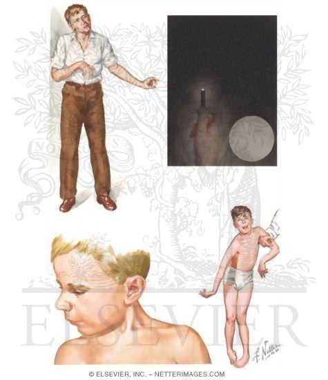 Movement: Hyperkinetic Disorders