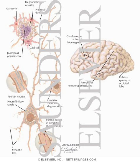 Watermarked preview of labeled image: Alzheimer's Disease