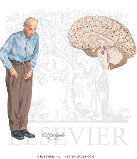 Watermarked preview of unlabeled image: Dementia With Lewy Bodies